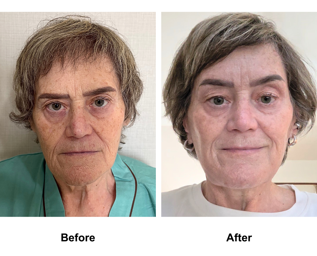 Sarah, 65 had MFNL + Chin lift with Dr. Ring-1