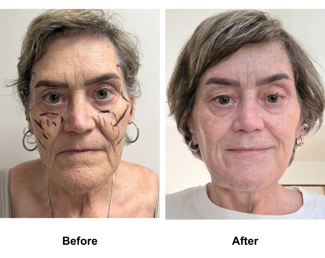 Sarah, 65 had MFNL + Chin lift with Dr. Ring