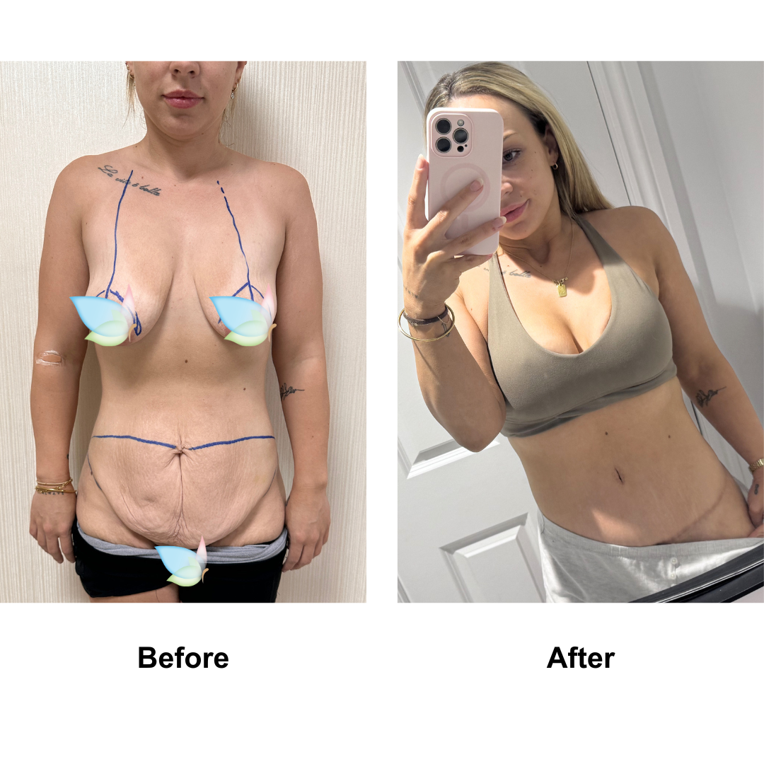Shanelle had Ex TT  + BABL (275 HP) with Dr. Ring - 2 years PO