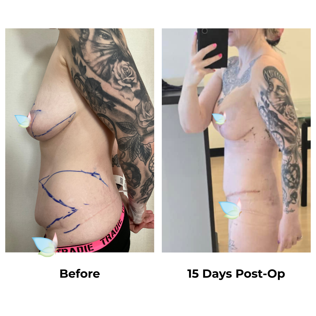 Sharla had skin removal with Dr. Weerachai (2)