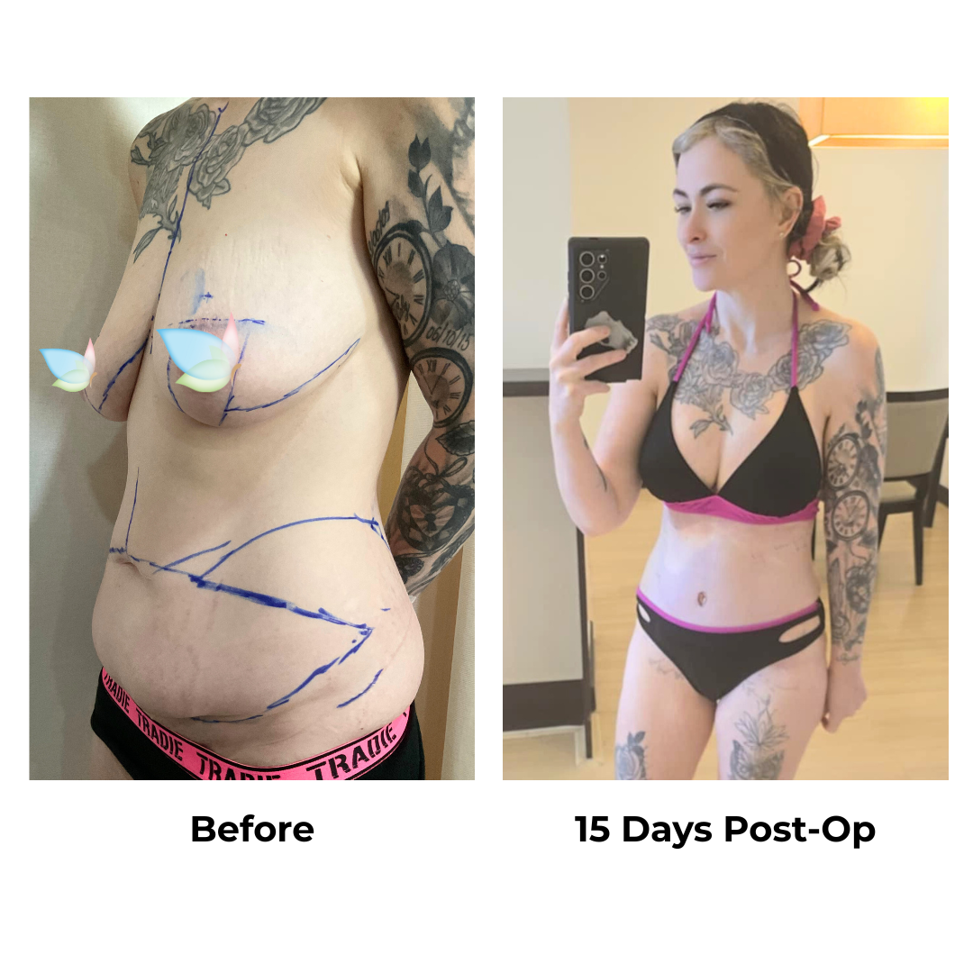 Sharla had skin removal with Dr. Weerachai (3)