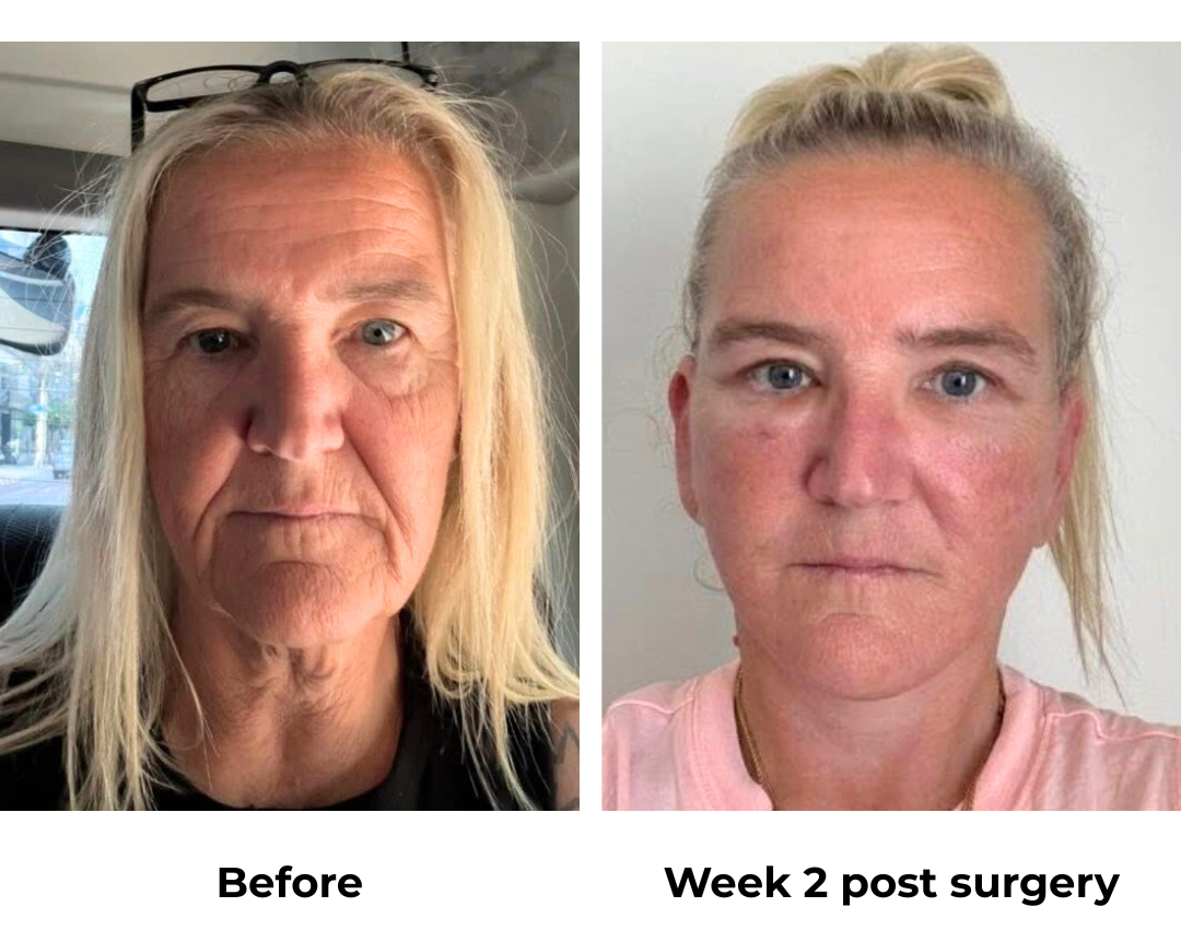 Sharon had MFNL + UB + Fat transfer with Dr. NJ (2)