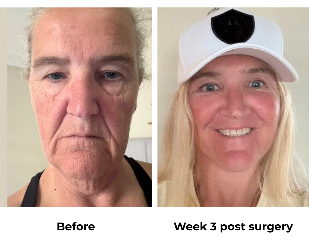 Sharon had MFNL + UB + Fat transfer with Dr. NJ (3)