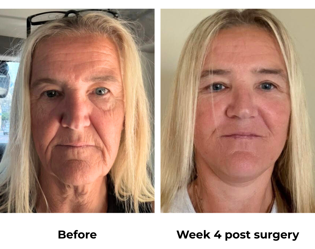 Sharon had MFNL + UB + Fat transfer with Dr. NJ (4)