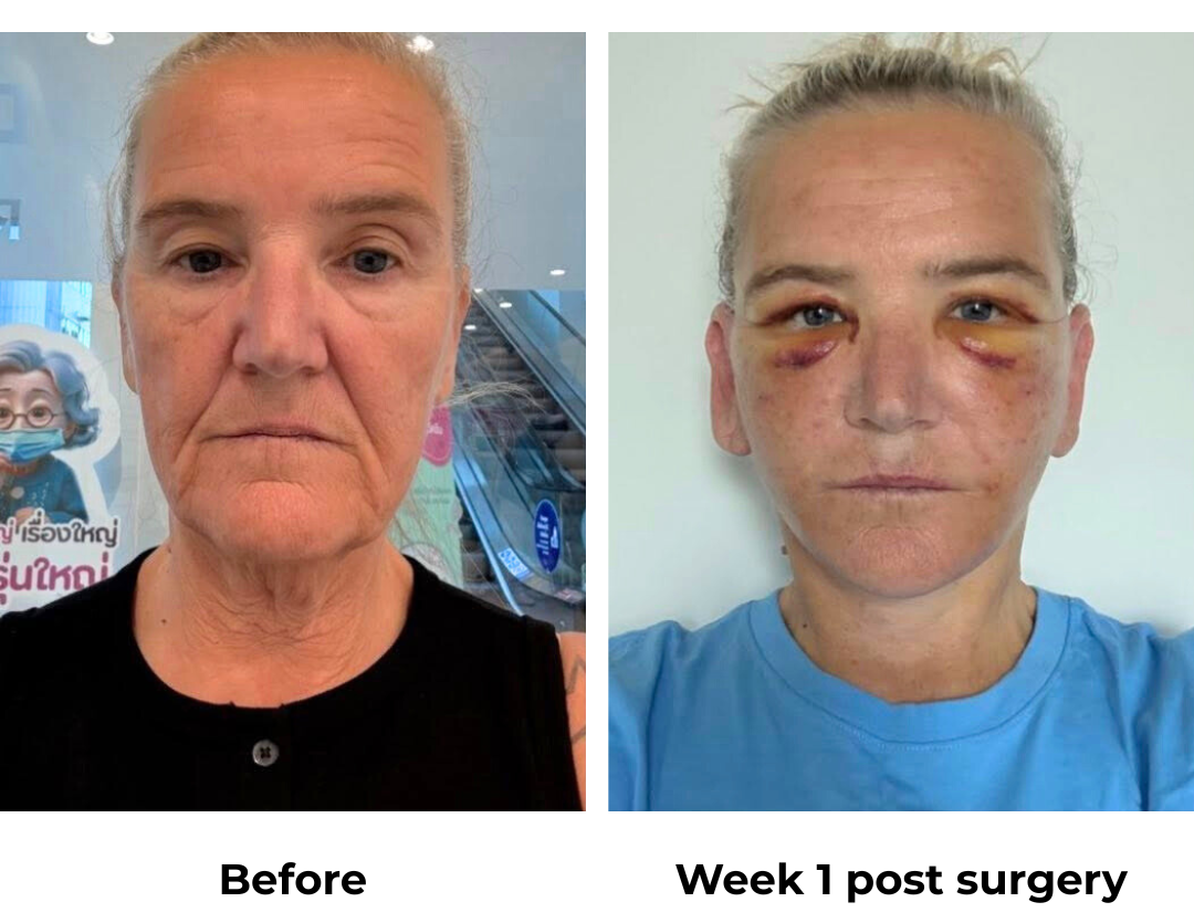 Sharon had MFNL + UB + Fat transfer with Dr. NJ