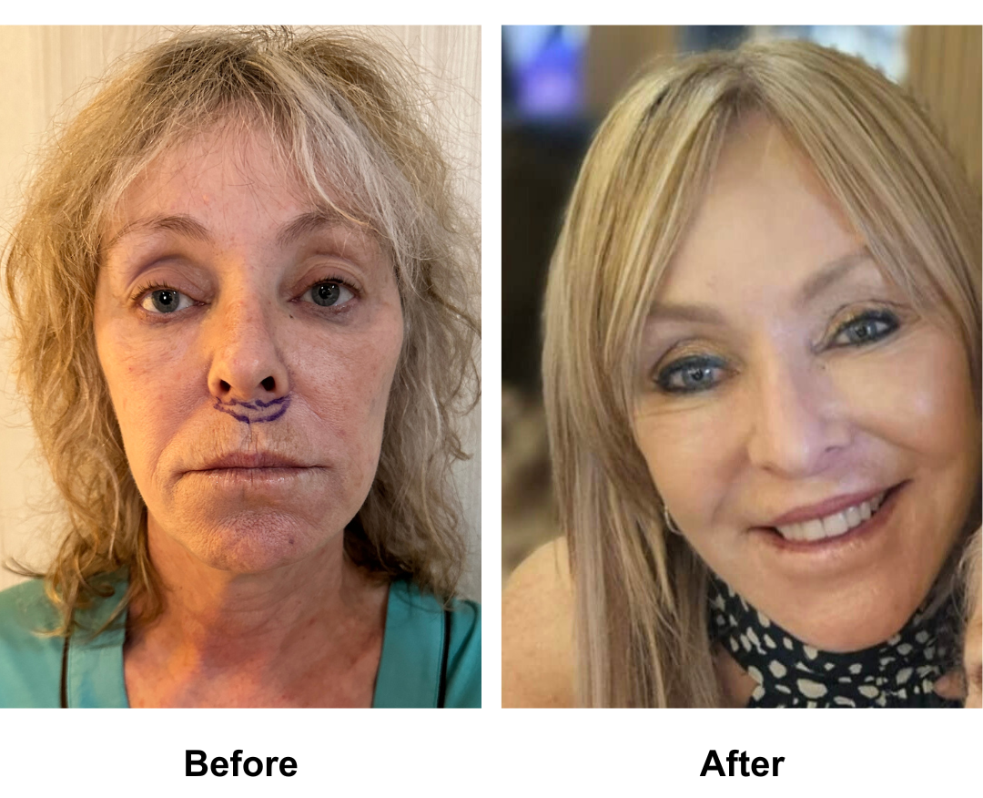 Sharon had Rev. MFNL + UB + Lip Lift + Fat transfer to Face with Dr. NJ  (1)