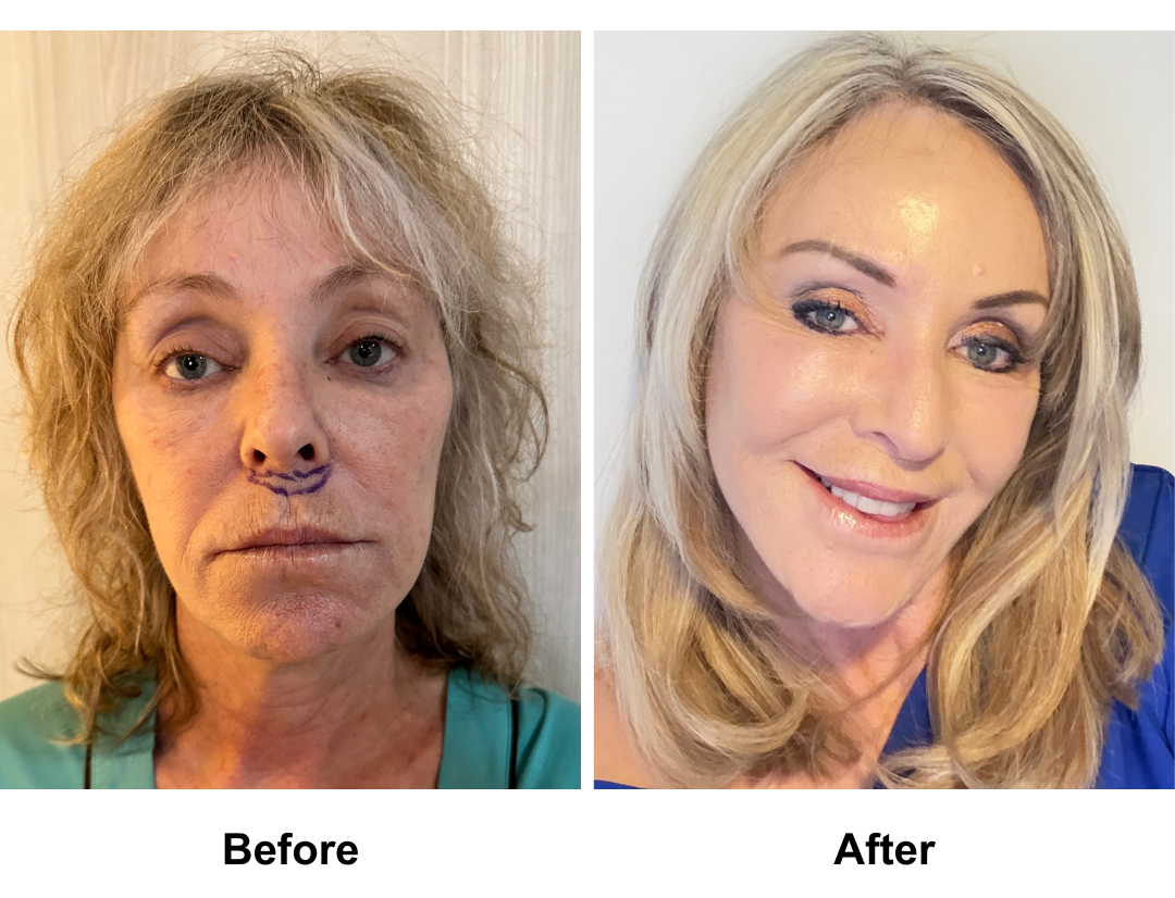 Sharon had Rev. MFNL + UB + Lip Lift + Fat transfer to Face with Dr. NJ