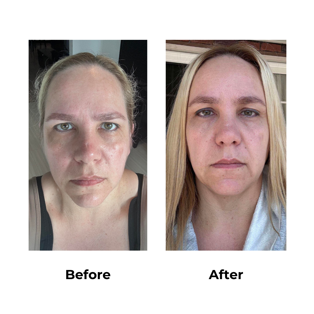 Sharon had endoscopic brow lift with Dr. Jatuporn - 1 month post-op