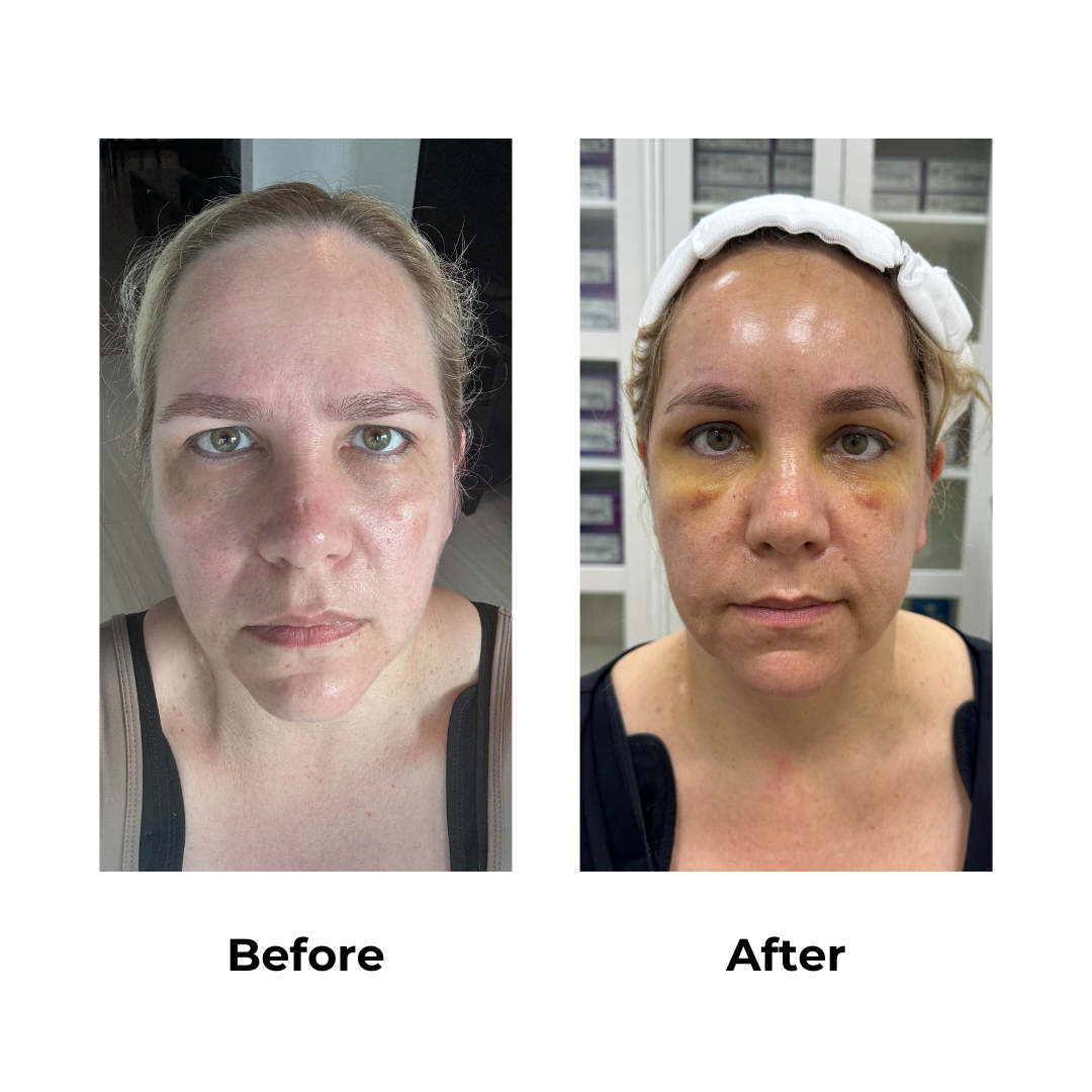 Sharon had endoscopic brow lift with Dr. Jatuporn - 5 days post-op