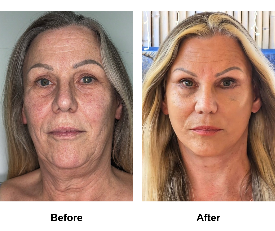 Sharon, 60 had FFNL + Chin Lift + Lower eyelids + Fat transfer to face with Dr. NJ