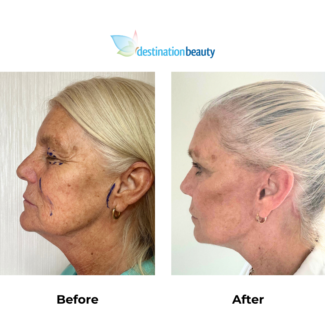 Sharons 10 weekspost-facelift