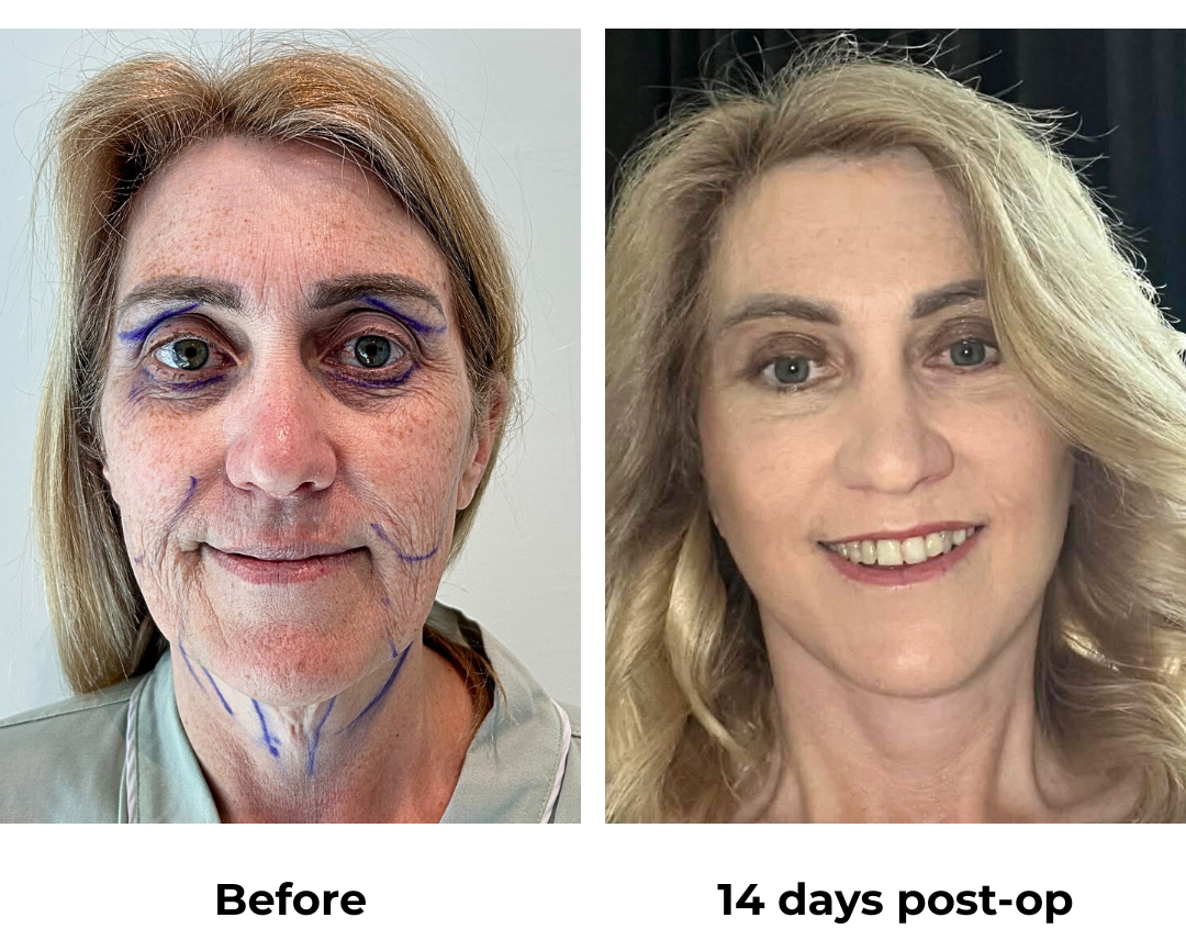 Sharyn had MFNL + LB + Sub Brow Lift + Chin Lift  with Dr. Jatuporn (1)