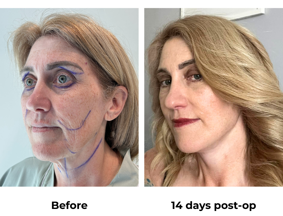Sharyn had MFNL + LB + Sub Brow Lift + Chin Lift  with Dr. Jatuporn