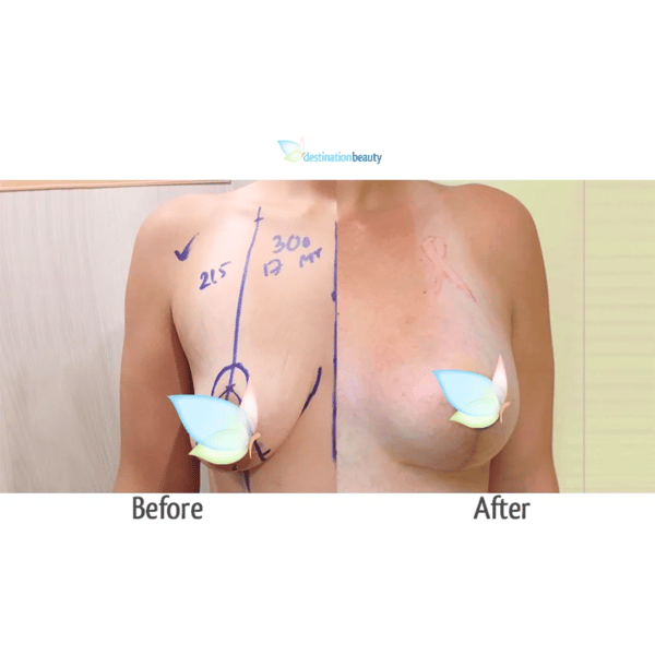 Shauna breast augmentation