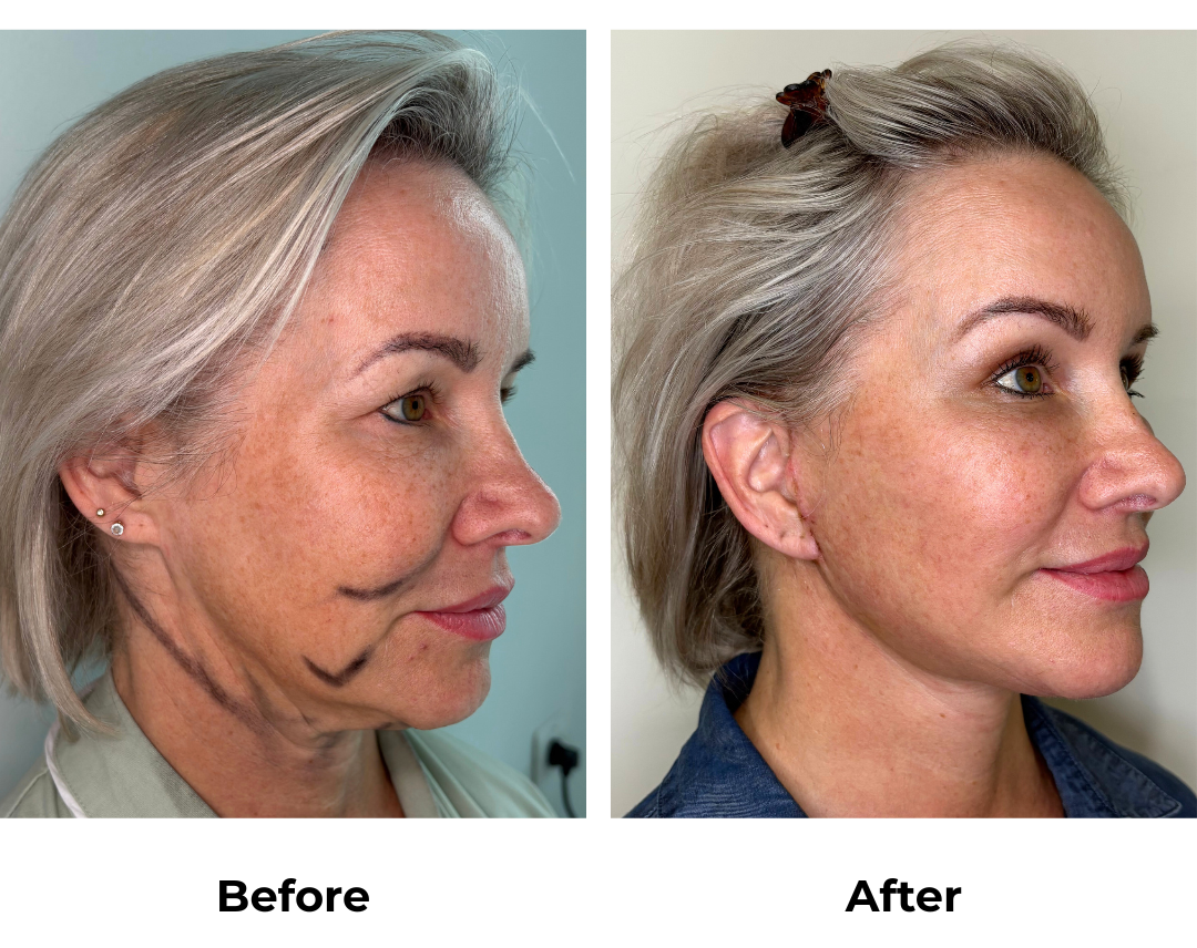 Shauna had MFNL + EBL with Dr. Jatuporn (1)