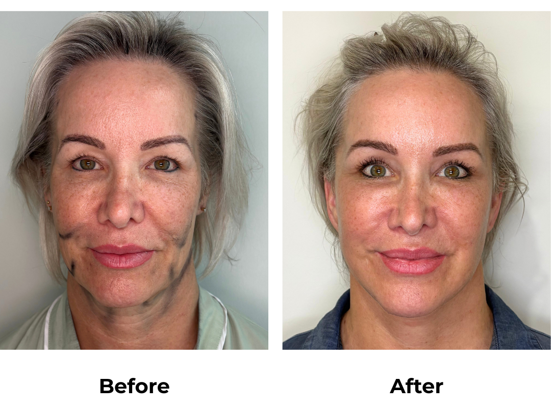 Shauna had MFNL + EBL with Dr. Jatuporn (2)