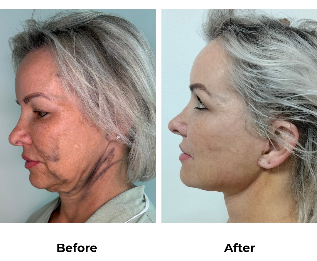 Shauna had MFNL + EBL with Dr. Jatuporn (3)