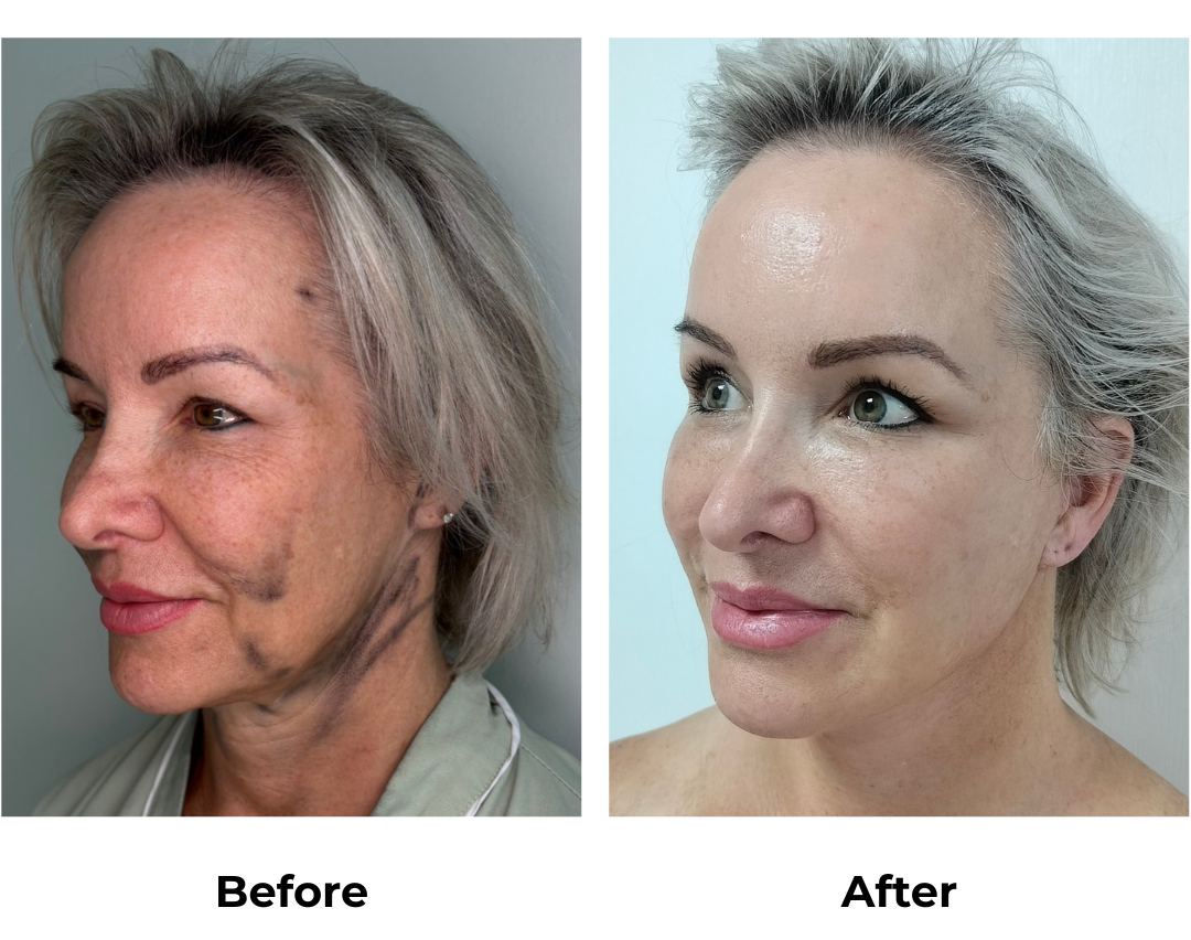 Shauna had MFNL + EBL with Dr. Jatuporn (4)