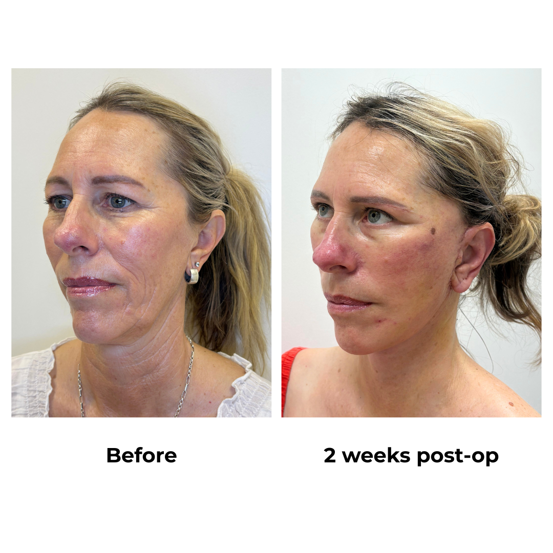 Shelley had FFNL + Sub Brow Lift with Dr. NJ (3)