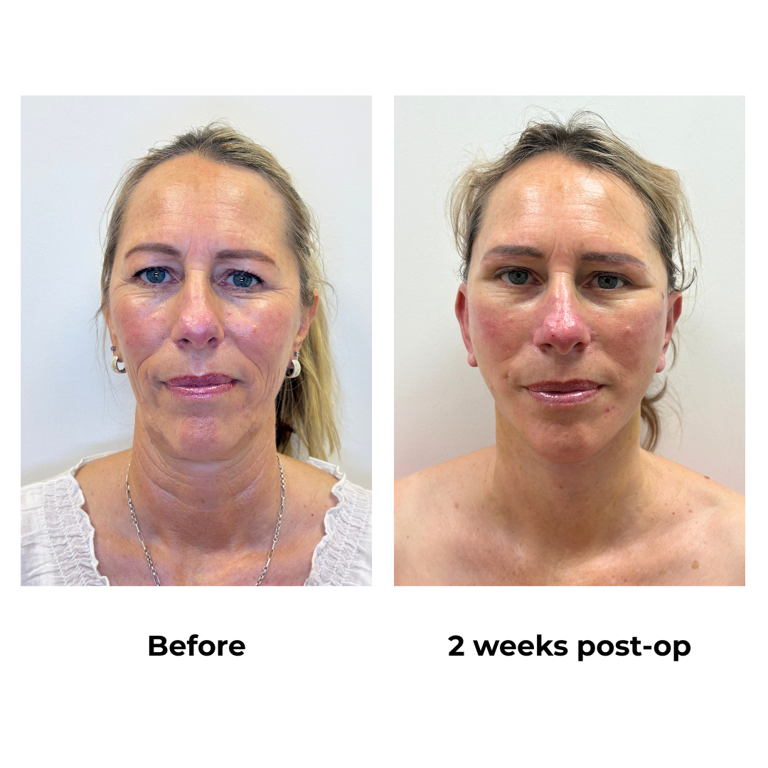 Shelley had FFNL + Sub Brow Lift with Dr. NJ