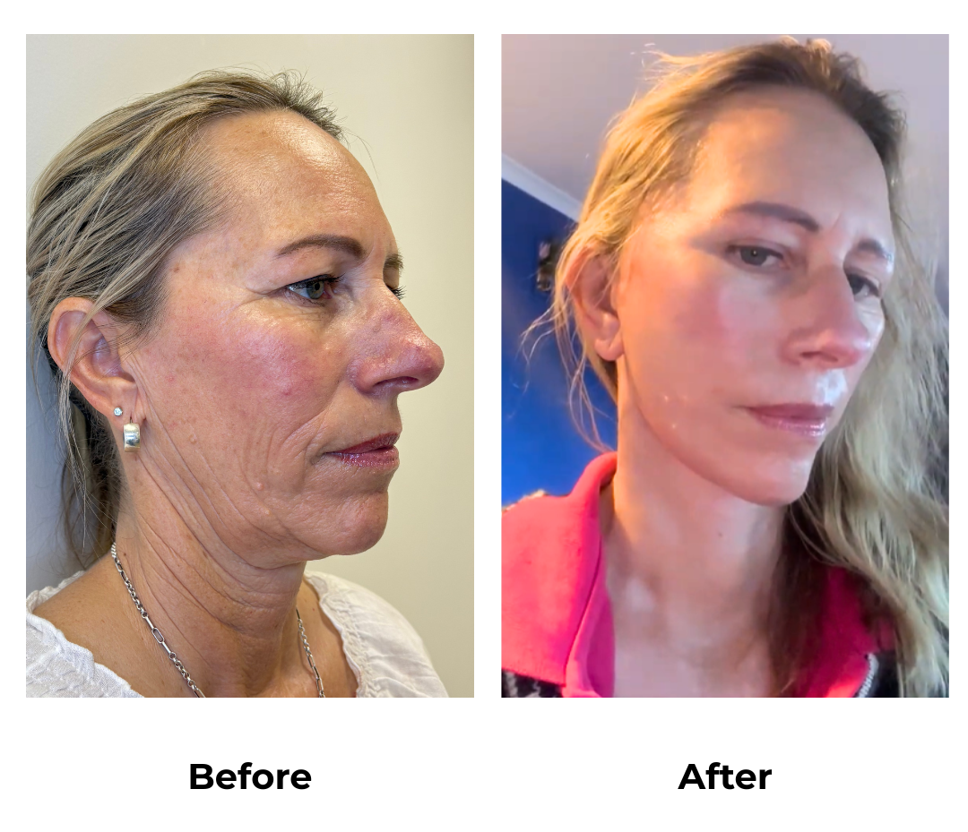 Shelley had Full Facelift, Neck Lift, and Sub-Brow Lift with Dr. NJ (3)