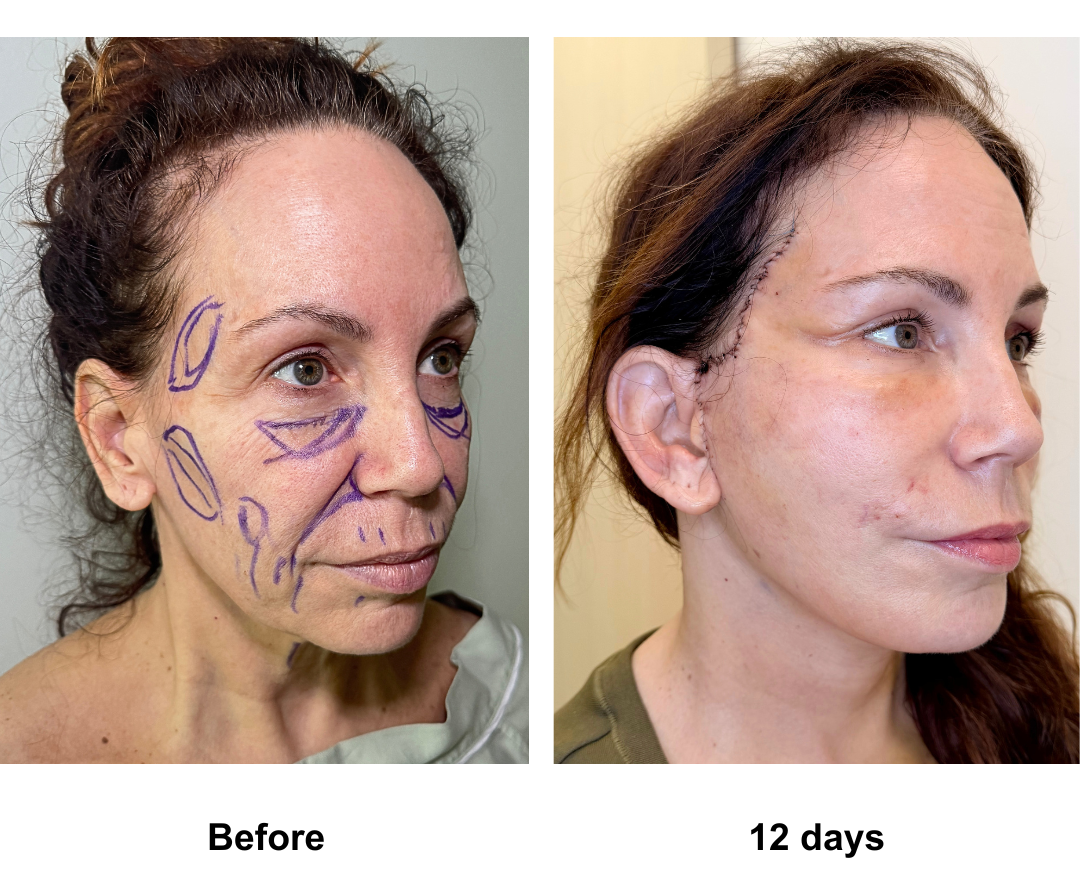 Sheree had Rev. FFNL + Fat transfer to face with Dr. NJ (2)