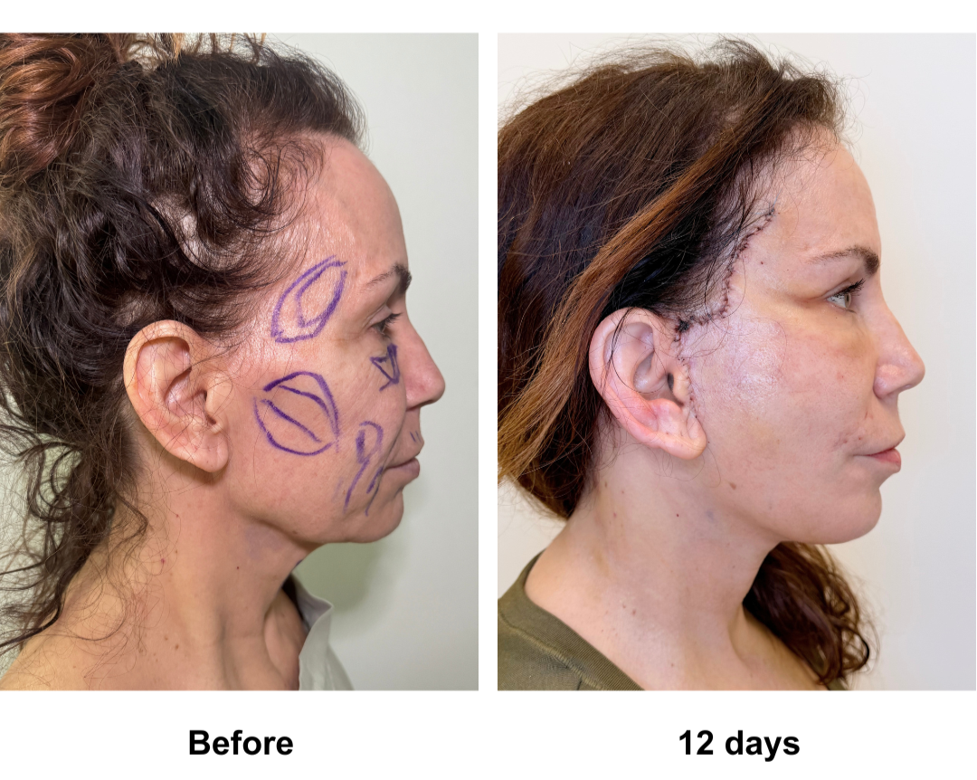 Sheree had Rev. FFNL + Fat transfer to face with Dr. NJ (3)
