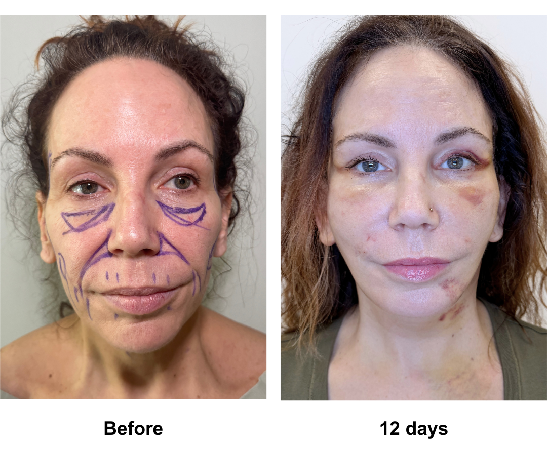 Sheree had Rev. FFNL + Fat transfer to face with Dr. NJ
