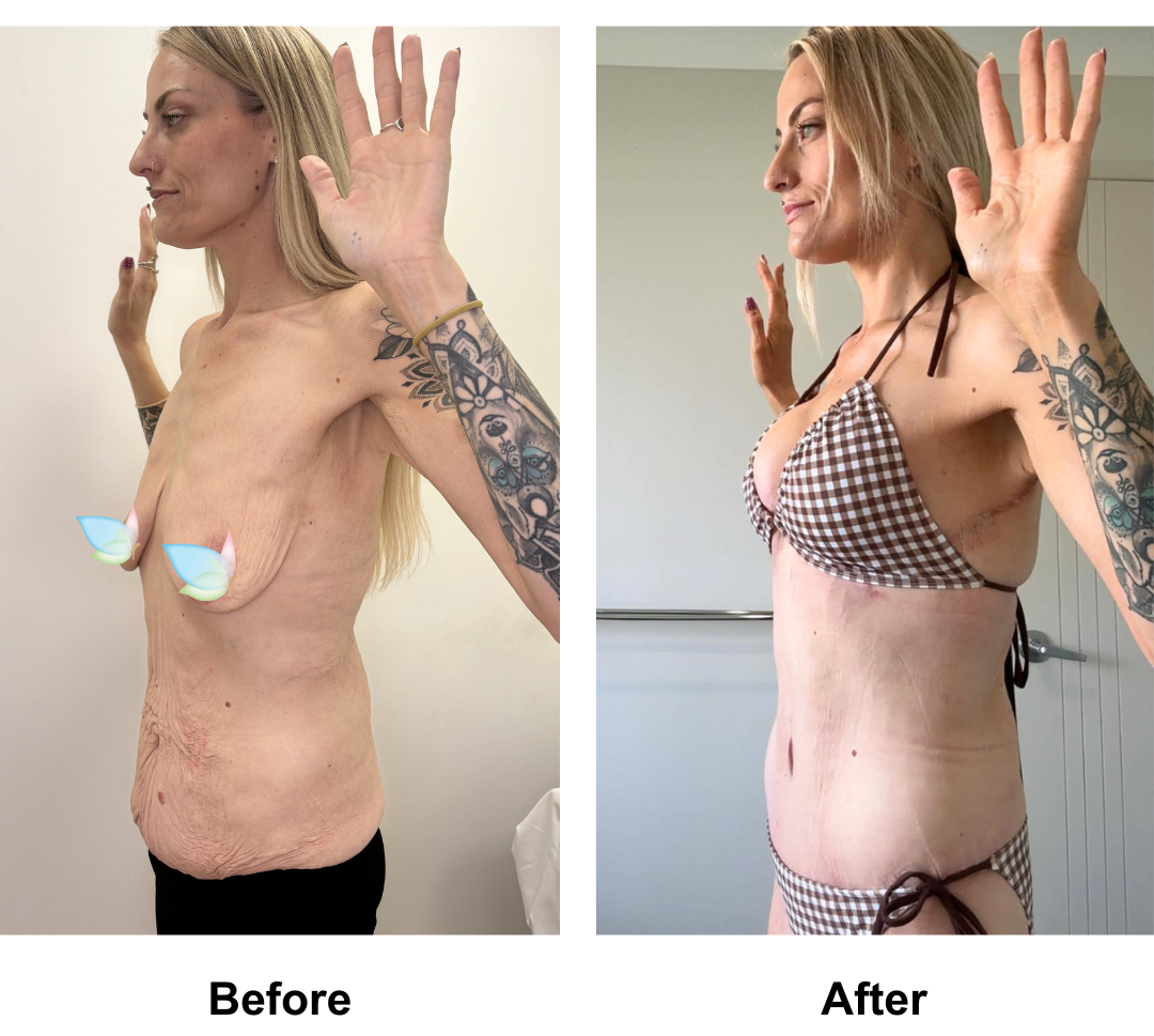 Sherilyn had BABL + SL + Semi-Circum TT + ML with Dr. Weerachai (2)