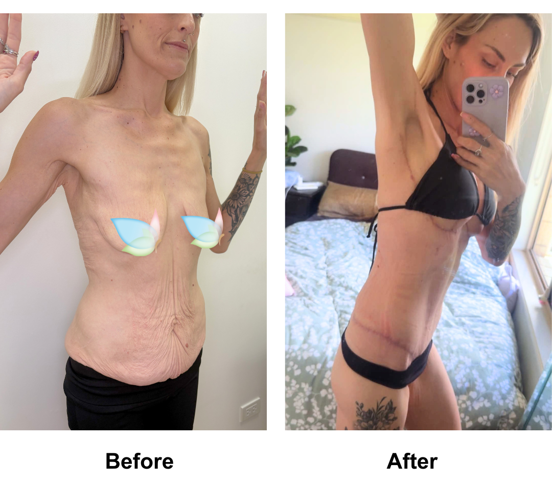 Sherilyn had BABL + SL + Semi-Circum TT + ML with Dr. Weerachai - 7 weeks (1)