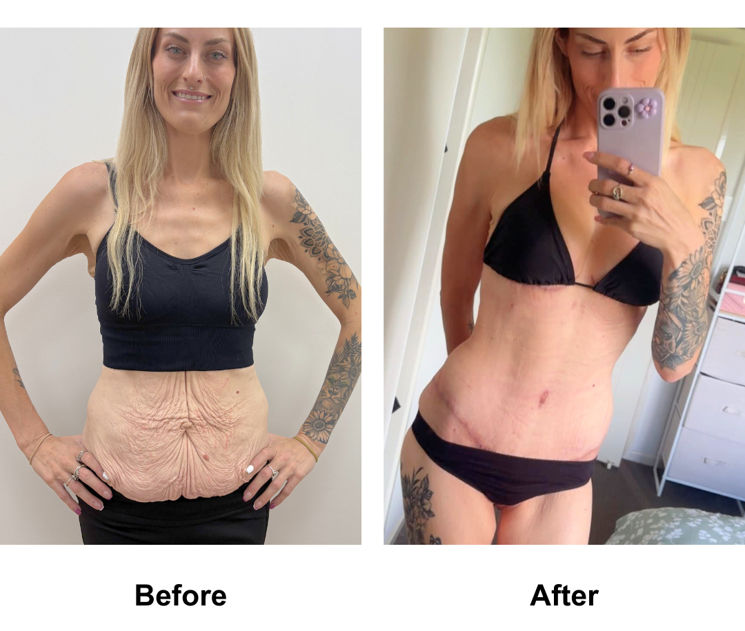 Sherilyn had BABL + SL + Semi-Circum TT + ML with Dr. Weerachai - 7 weeks