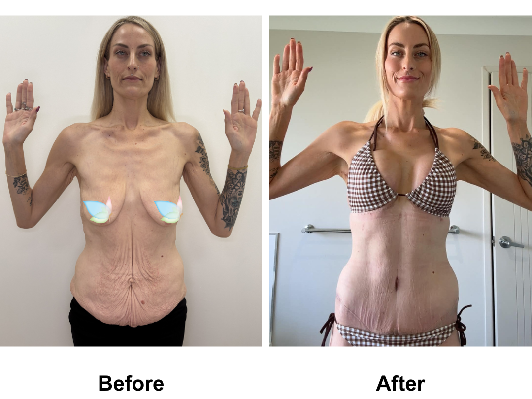 Sherilyn had BABL + SL + Semi-Circum TT + ML with Dr. Weerachai