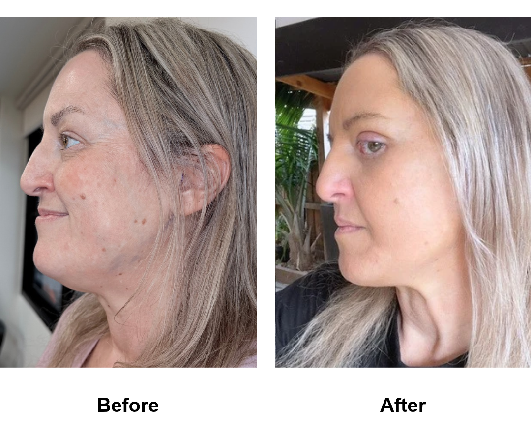 Simone, 47 had MFNL + UB + LB with Dr. Ring - 2 months  (1)