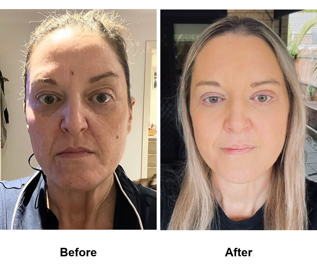 Simone, 47 had MFNL + UB + LB with Dr. Ring - 2 months