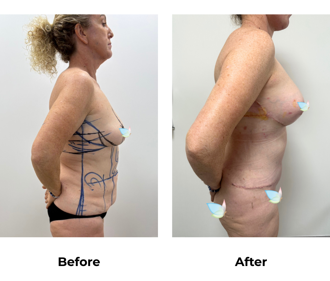 Sionna had BABL + ExTT + Lipo 2 areas + AL + Braline lift + Side lift with Dr. Jatuporn (2)