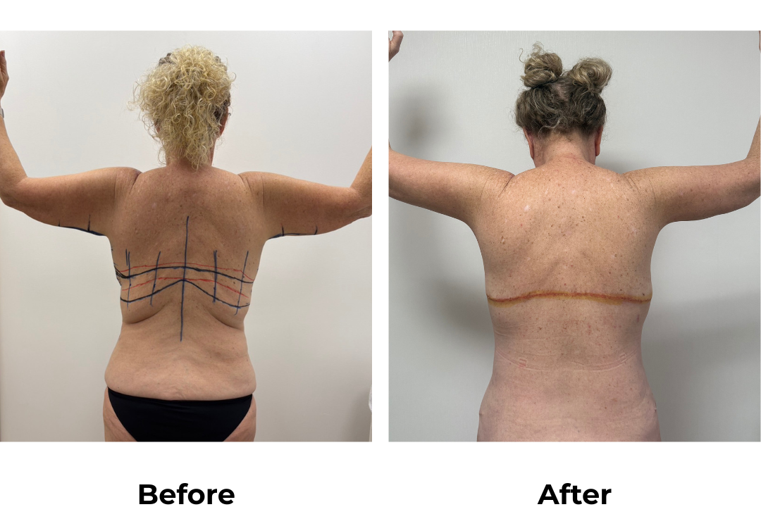 Sionna had BABL + ExTT + Lipo 2 areas + AL + Braline lift + Side lift with Dr. Jatuporn (3)
