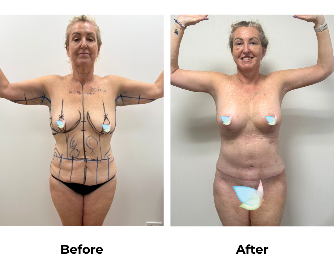 Sionna had BABL + ExTT + Lipo 2 areas + AL + Braline lift + Side lift with Dr. Jatuporn