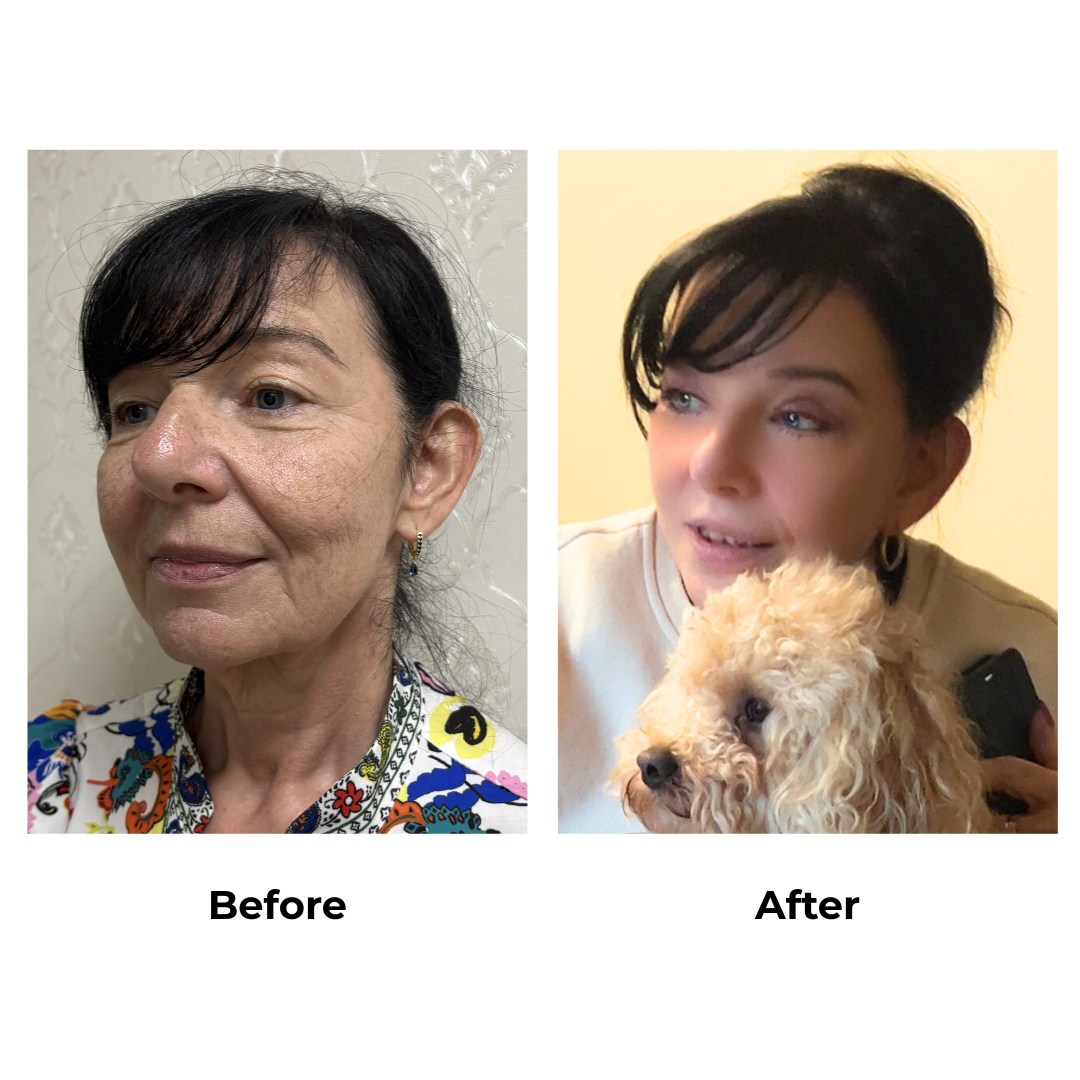 Sonia had _Mid Face + Neck Lift + UB + LB  with Dr. Ring (3)