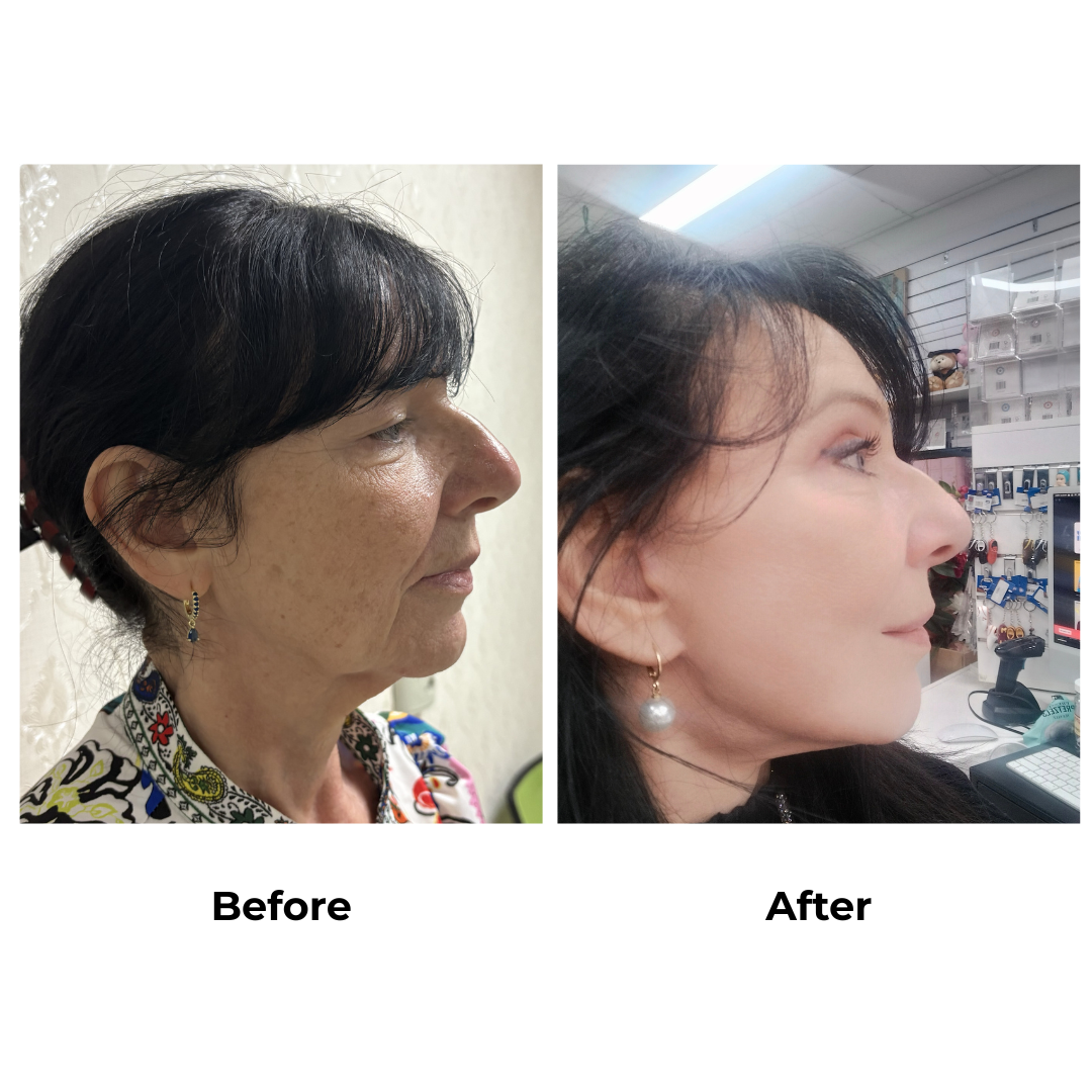 Sonia had _Mid Face + Neck Lift + UB + LB  with Dr. Ring