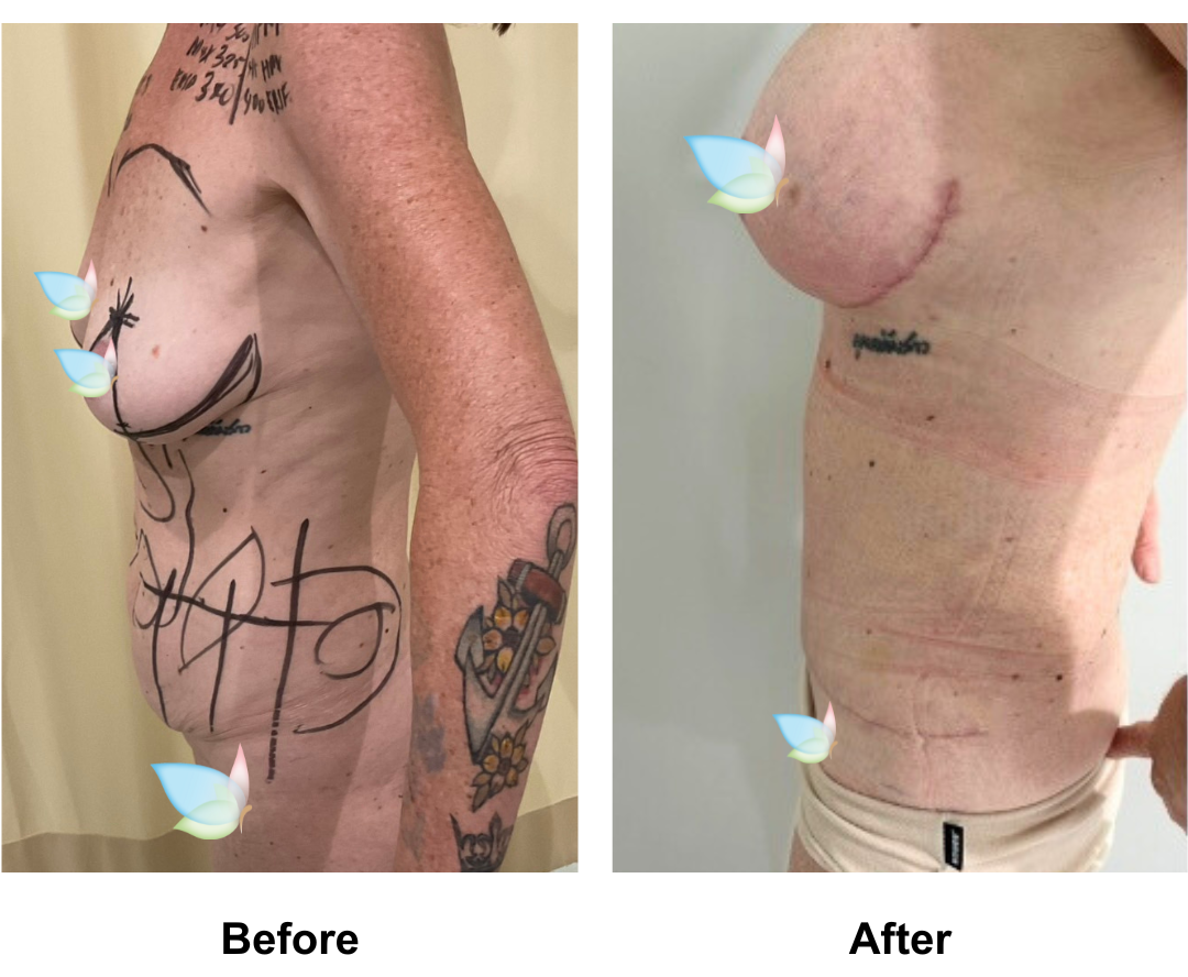 Sonja had BABL(400 Motiva) + Ex TT + Mons lift + Lipo at love handle + upper ab   (1)