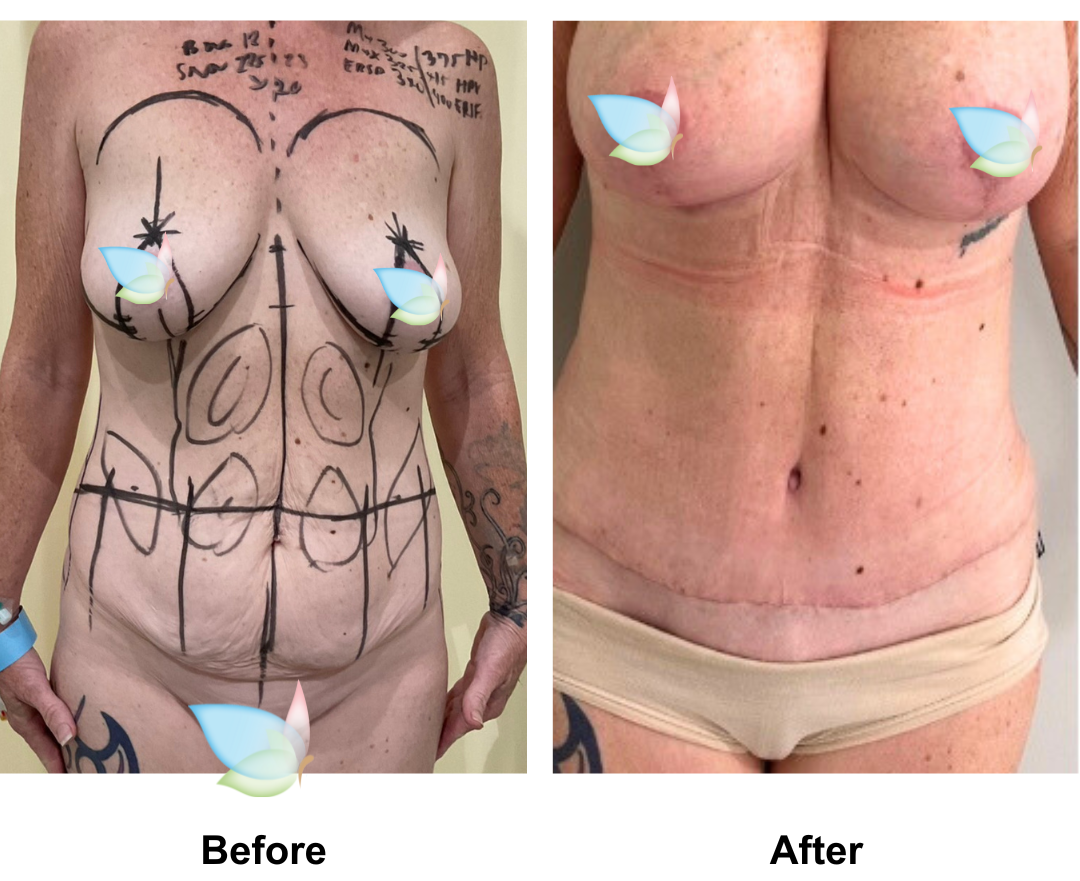 Sonja had BABL(400 Motiva) + Ex TT + Mons lift + Lipo at love handle + upper ab