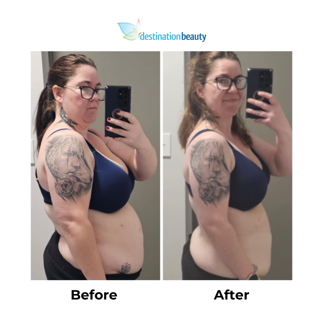 Stefanies 7 months post-gastric sleeve (2)