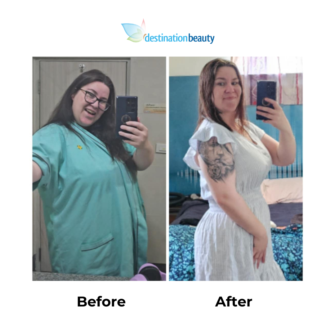 Stefanies 7 months post-gastric sleeve (3)