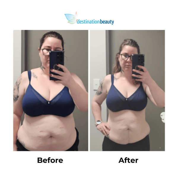 Stefanies 7 months post-gastric sleeve