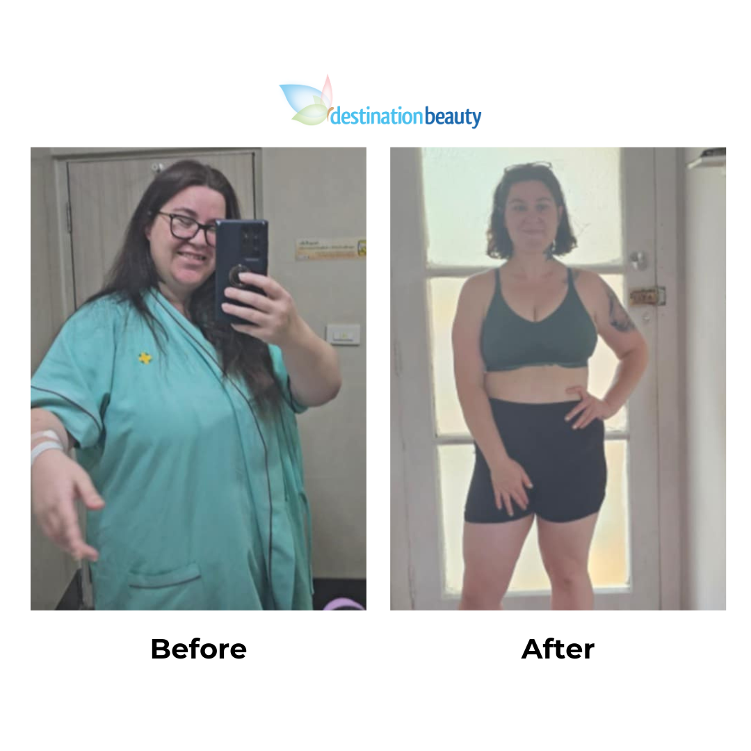 Stefanies 8 months post-gastric sleeve