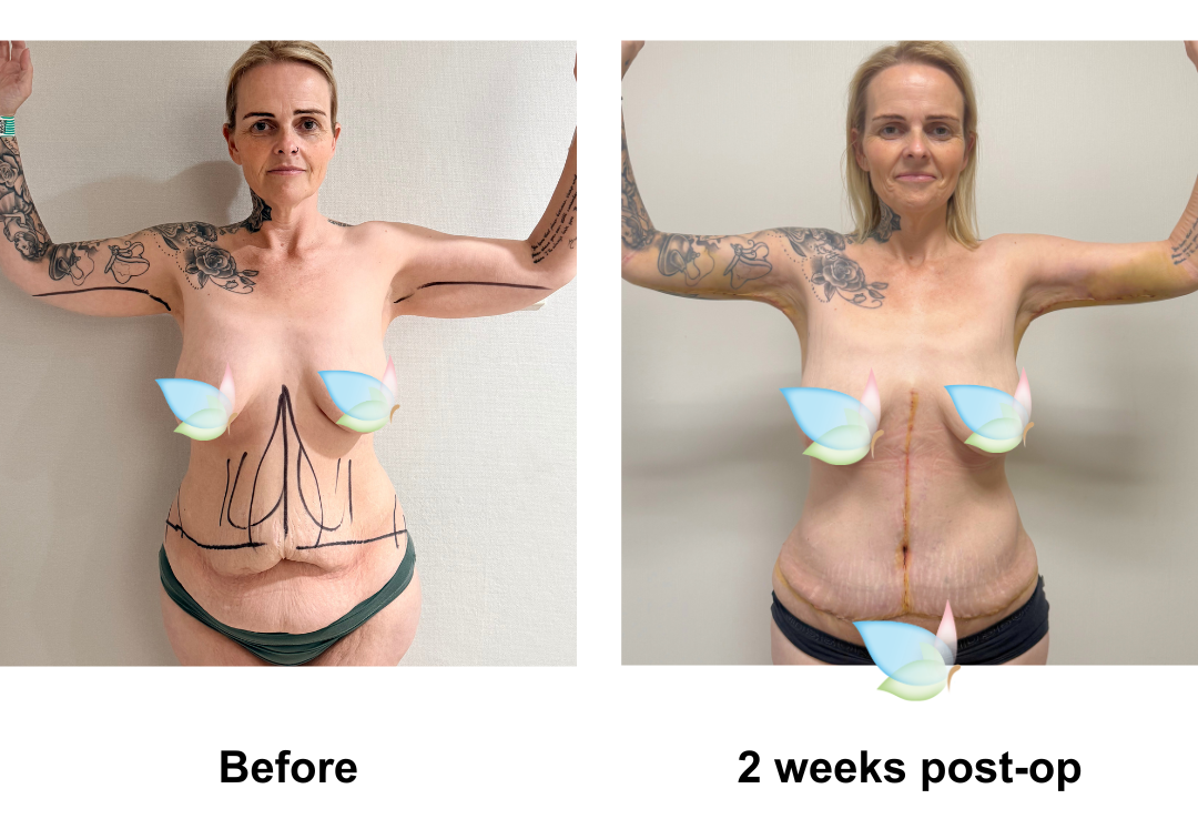 Stephanie had Fleur De Lis Tummy Tuck + ML + Lipo3 (upper abs, love handles, arm) + AL with Dr. Kasemsak