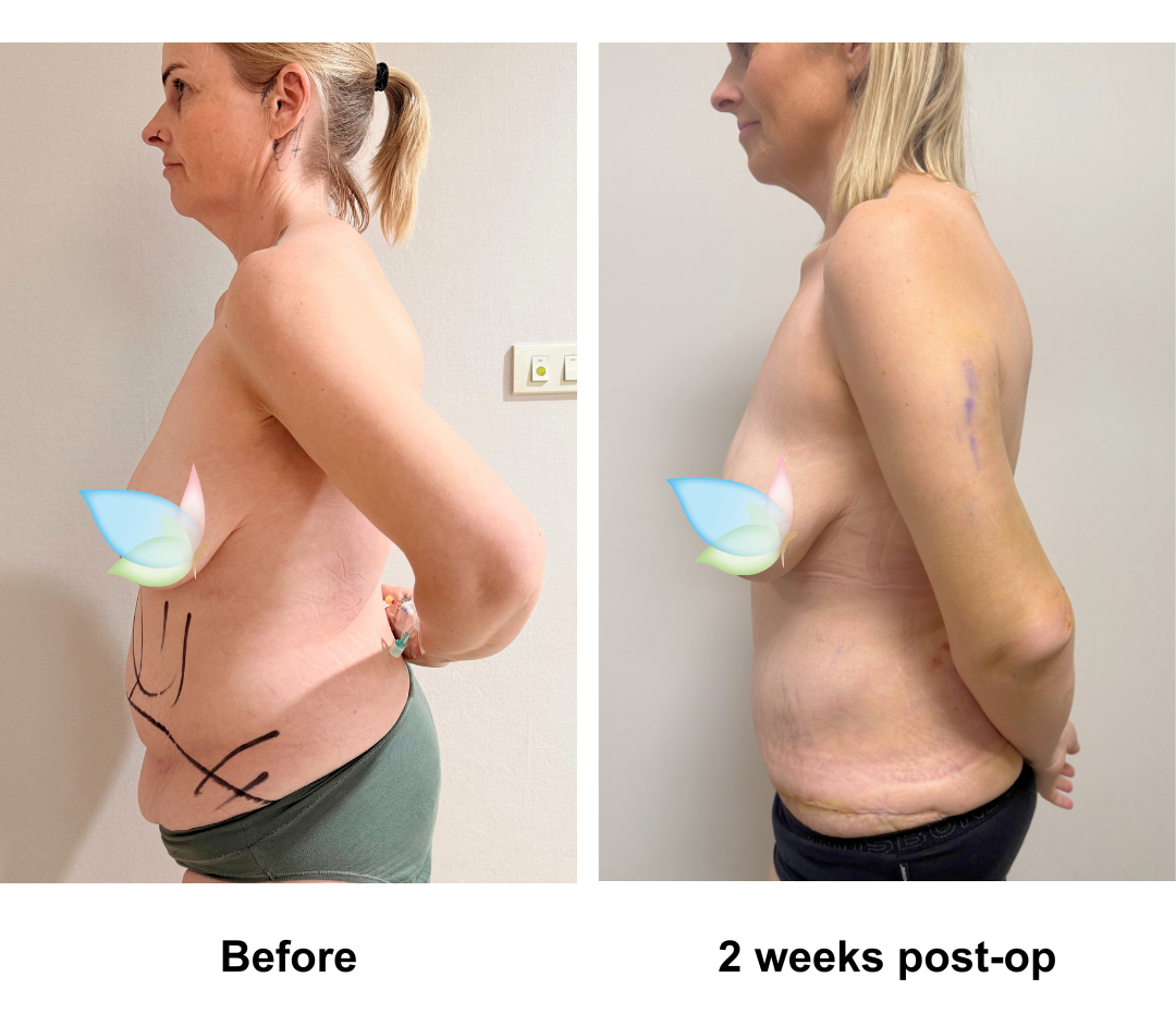 Stephanie had Fleur De Lis Tummy Tuck + ML + Lipo_3 (upper abs, love handles, arm) + AL with Dr. Kasemsak (2)
