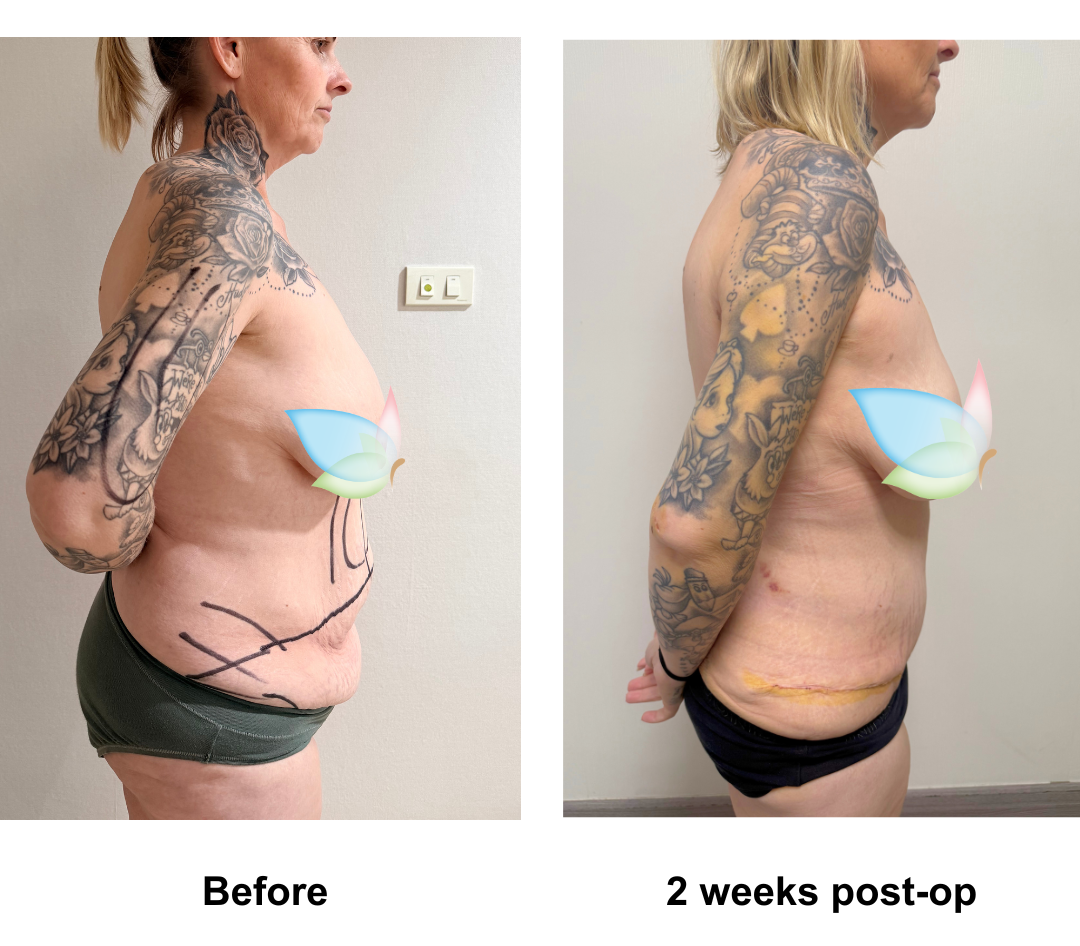Stephanie had Fleur De Lis Tummy Tuck + ML + Lipo_3 (upper abs, love handles, arm) + AL with Dr. Kasemsak (3)