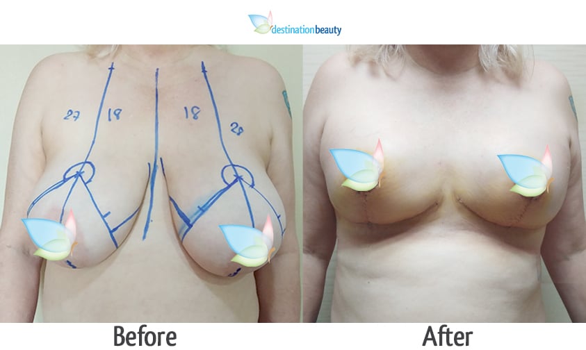 Sue breast reduction