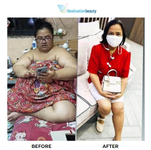 Sunisa weight loss surgery